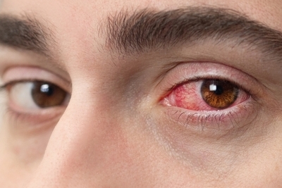 Man suffering in eye injuries